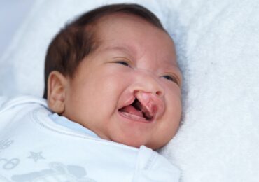 antalya dudak damak yarığı tedavisi