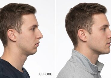 antalya alt çene geriliği tedavisi