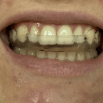 stabilzasyon splinti nedir