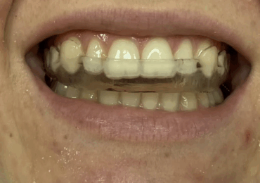 stabilzasyon splinti nedir