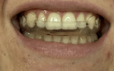 stabilzasyon splinti nedir