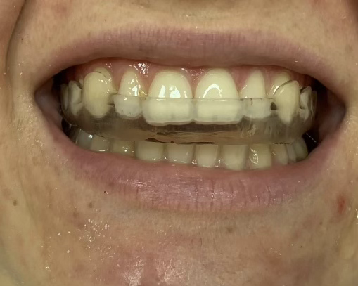 stabilzasyon splinti nedir